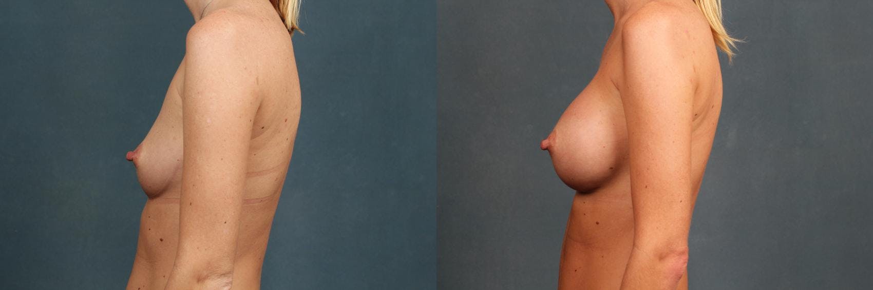 Revision Before & After Gallery - Patient 103122 - Image 3