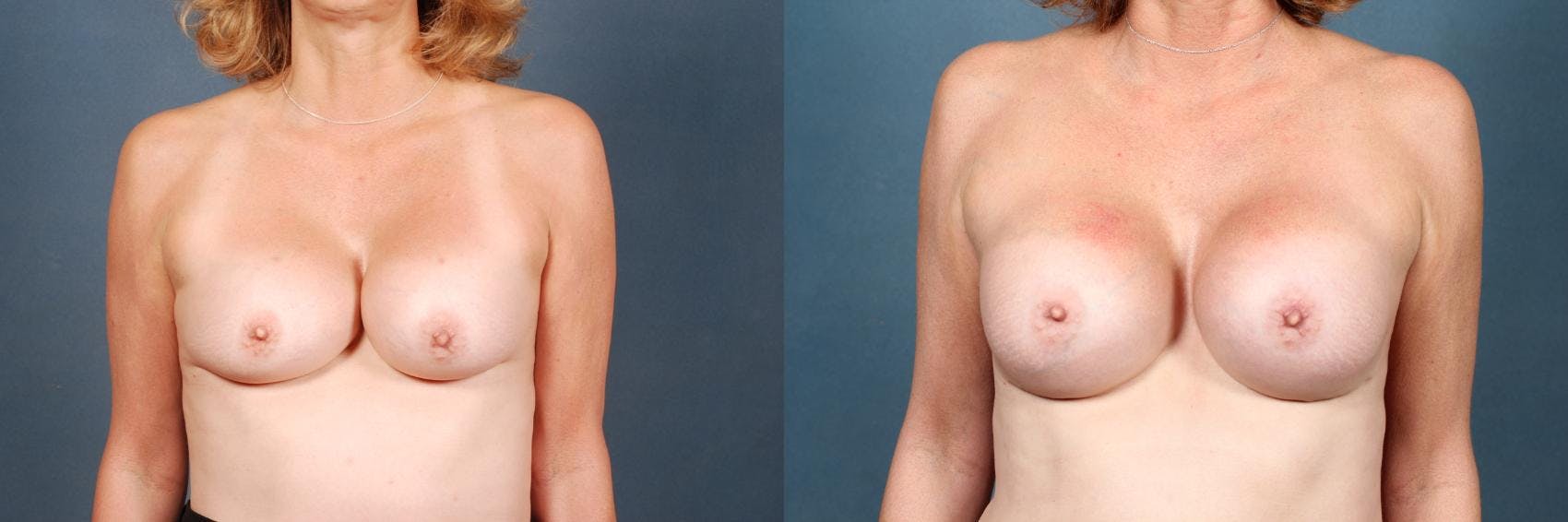 Revision Before & After Gallery - Patient 297949 - Image 1