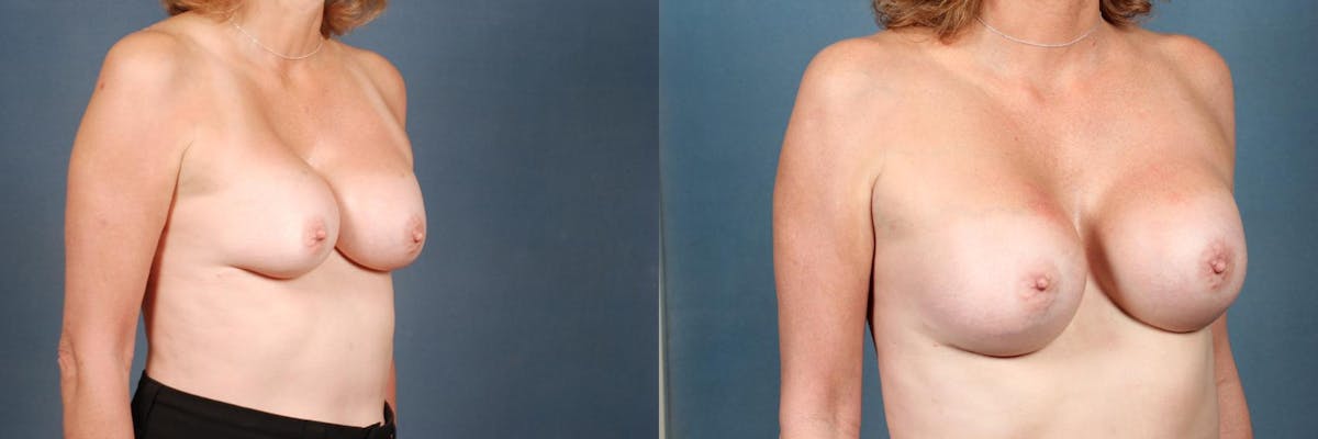 Revision Before & After Gallery - Patient 297949 - Image 3