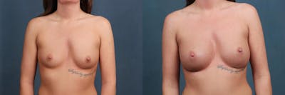 Revision Before & After Gallery - Patient 229952 - Image 1