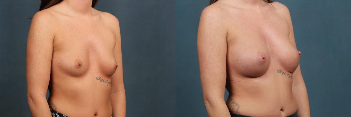 Revision Before & After Gallery - Patient 229952 - Image 2