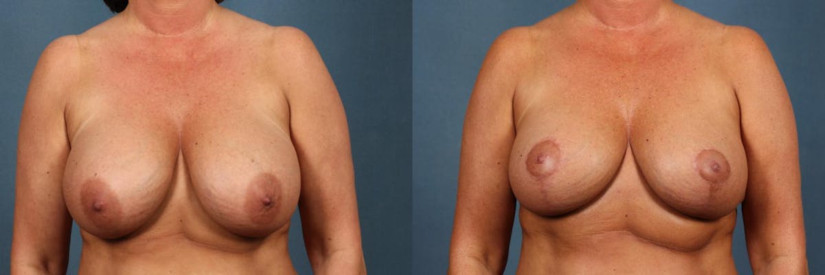 Revision Before & After Gallery - Patient 210781 - Image 1