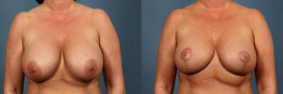 Revision Before & After Gallery - Patient 210781 - Image 1