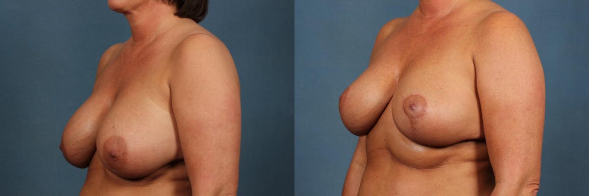 Revision Before & After Gallery - Patient 210781 - Image 3