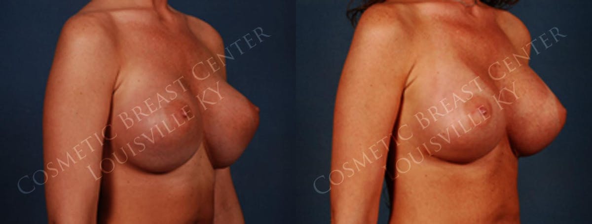 Revision Before & After Gallery - Patient 100116 - Image 2