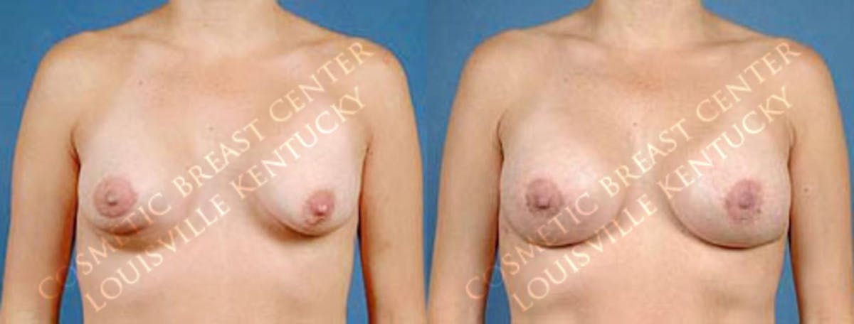 Revision Before & After Gallery - Patient 100227 - Image 1