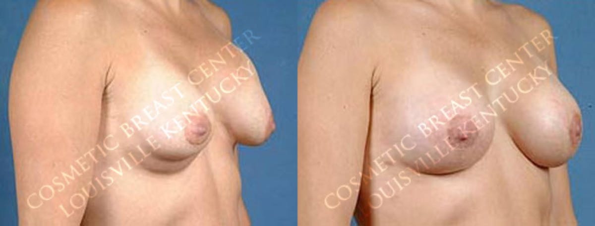 Revision Before & After Gallery - Patient 100227 - Image 2