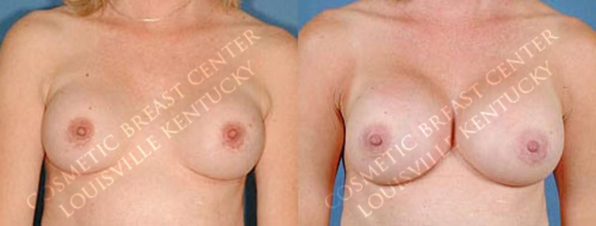 Revision Before & After Gallery - Patient 767846 - Image 1