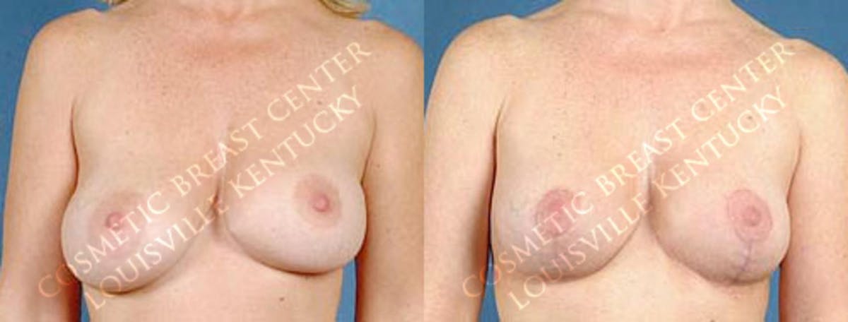 Revision Before & After Gallery - Patient 208903 - Image 1