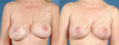 Revision Before & After Gallery - Patient 208903 - Image 1