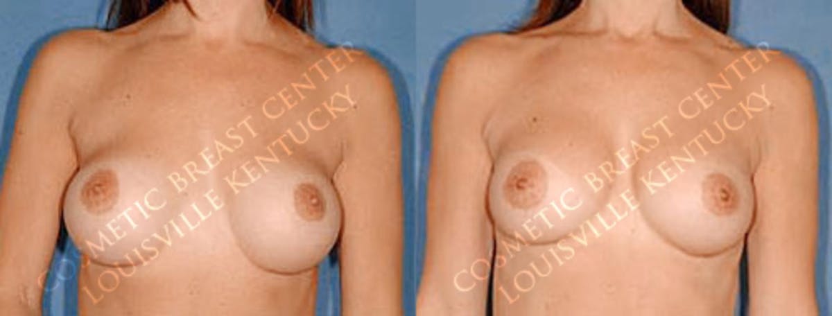 Revision Before & After Gallery - Patient 165763 - Image 1