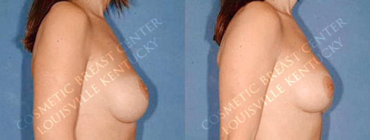 Revision Before & After Gallery - Patient 165763 - Image 2