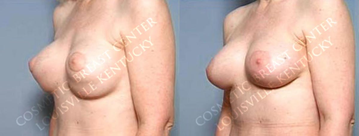 Revision Before & After Gallery - Patient 216748 - Image 2