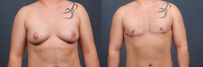 Top Surgery Before & After Gallery - Patient 328221 - Image 1