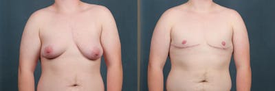 Top Surgery Before & After Gallery - Patient 142864 - Image 1