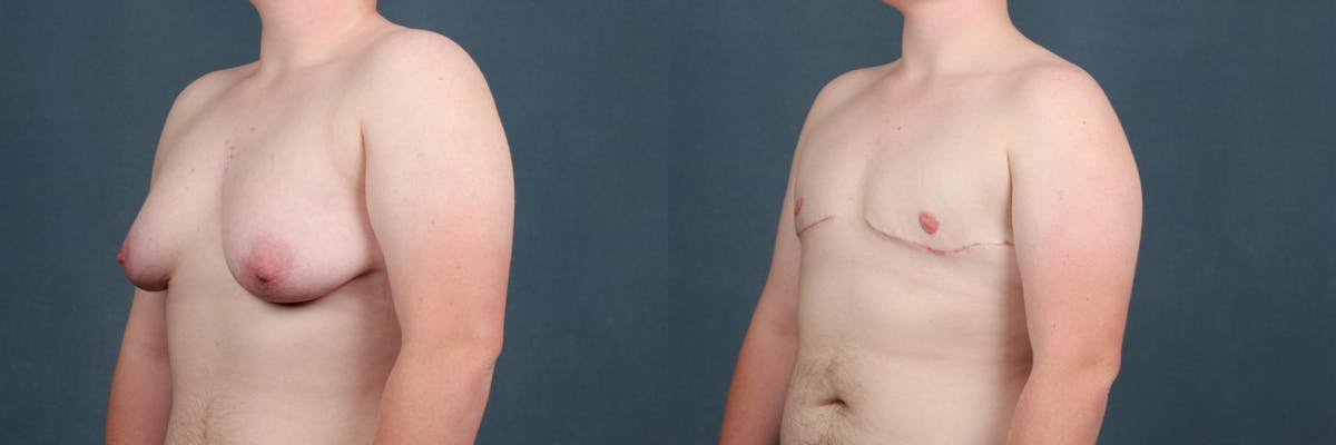 Top Surgery Before & After Gallery - Patient 142864 - Image 2