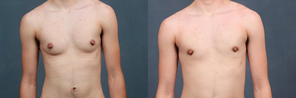 Top Surgery Before & After Gallery - Patient 426165 - Image 1