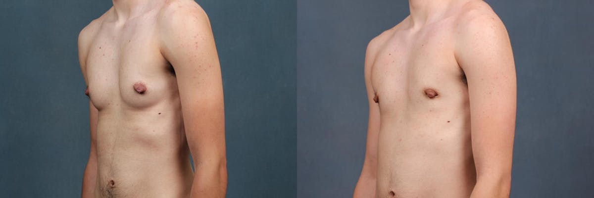 Top Surgery Before & After Gallery - Patient 426165 - Image 2