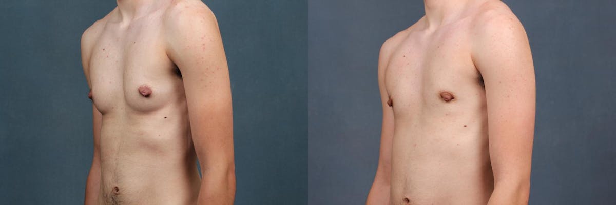 Top Surgery Before & After Gallery - Patient 103587 - Image 2