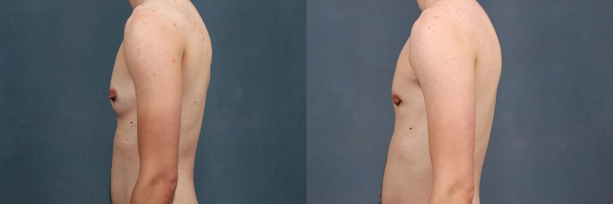 Top Surgery Before & After Gallery - Patient 103587 - Image 3