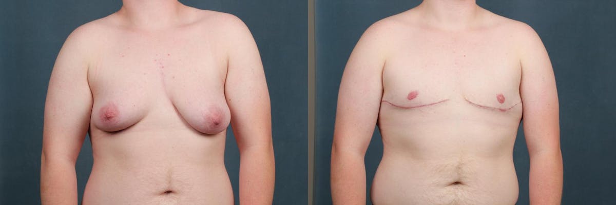 Top Surgery Before & After Gallery - Patient 108244 - Image 1