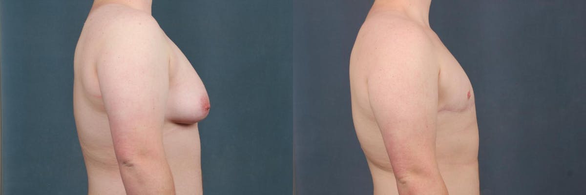 Top Surgery Before & After Gallery - Patient 108244 - Image 3