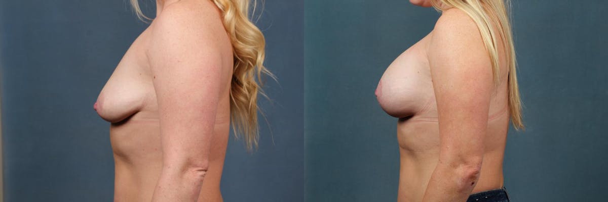 Lift Before & After Gallery - Patient 156067 - Image 3