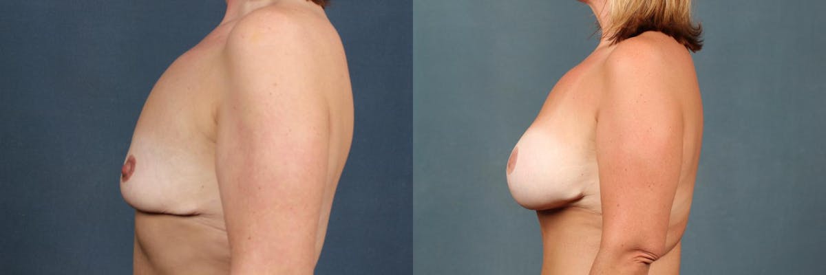 Lift Before & After Gallery - Patient 148713 - Image 3