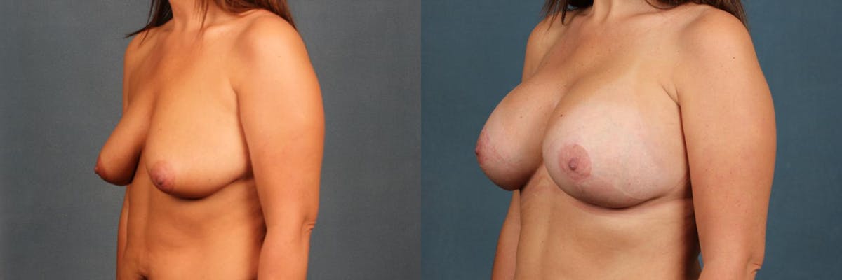 Lift Before & After Gallery - Patient 156004 - Image 2
