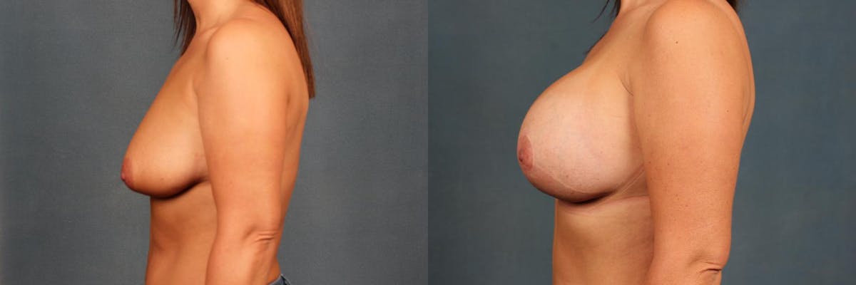 Lift Before & After Gallery - Patient 156004 - Image 3