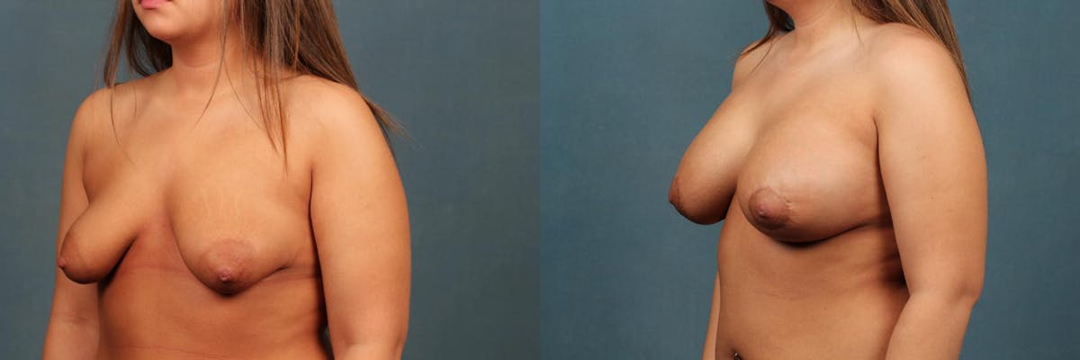 Lift Before & After Gallery - Patient 174004 - Image 2