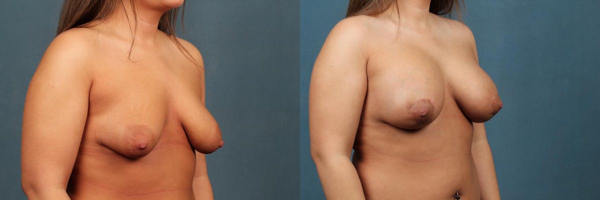 Lift Before & After Gallery - Patient 174004 - Image 4