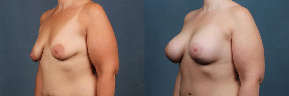 Lift Before & After Gallery - Patient 319088 - Image 2