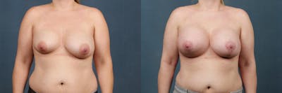 Lift Before & After Gallery - Patient 415789 - Image 1