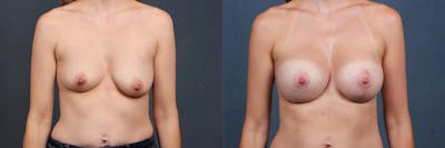 Lift Before & After Gallery - Patient 390346 - Image 1