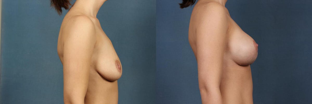 Lift Before & After Gallery - Patient 299475 - Image 3