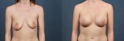 Lift Before & After Gallery - Patient 352505 - Image 1