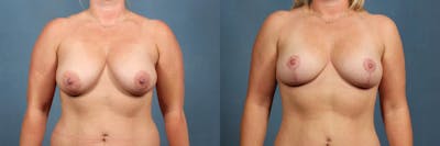 Lift Before & After Gallery - Patient 182556 - Image 1