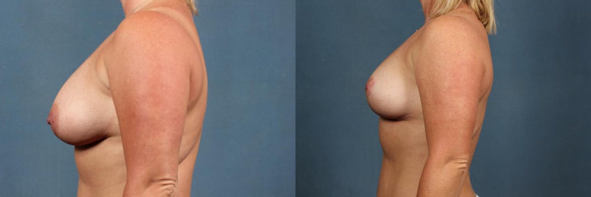 Lift Before & After Gallery - Patient 182556 - Image 3