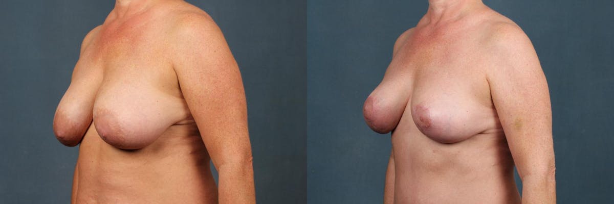 Lift Before & After Gallery - Patient 316842 - Image 2