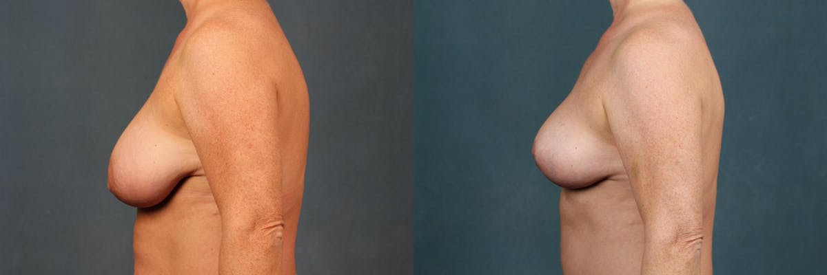 Lift Before & After Gallery - Patient 316842 - Image 3