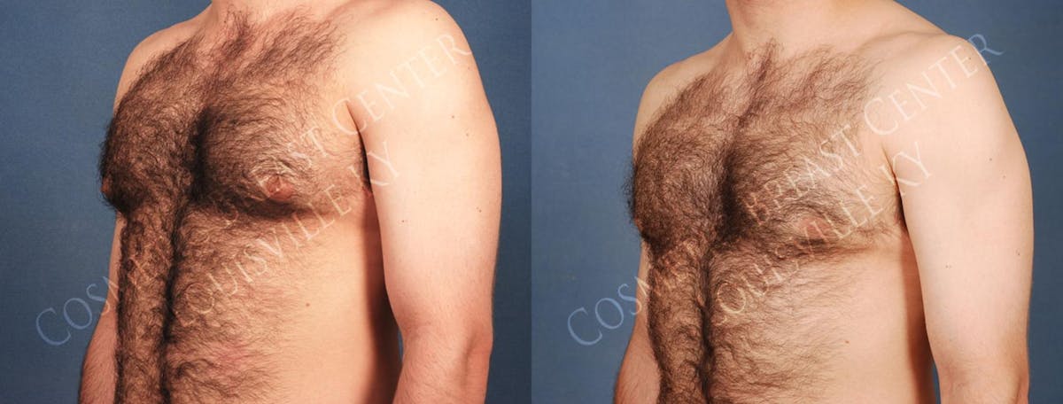 Male Reduction Before & After Gallery - Patient 254080 - Image 2