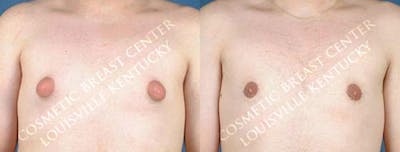 Male Reduction Before & After Gallery - Patient 125992 - Image 1