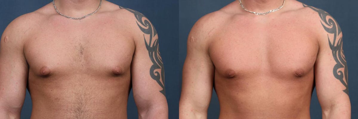 Male Reduction Before & After Gallery - Patient 396989 - Image 1
