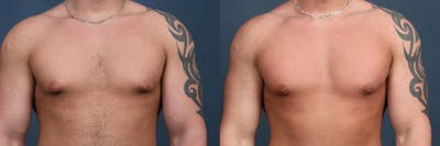 Male Reduction Before & After Gallery - Patient 396989 - Image 1