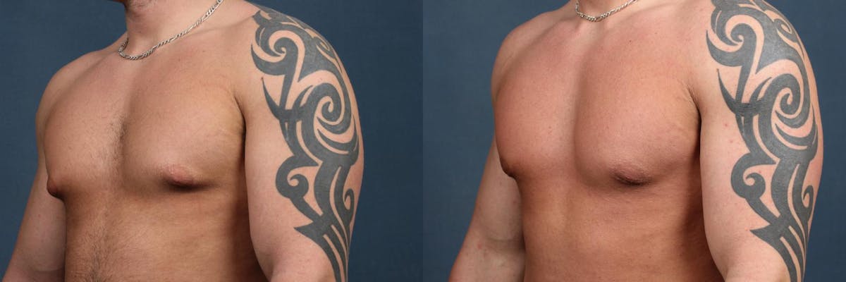 Male Reduction Before & After Gallery - Patient 396989 - Image 2