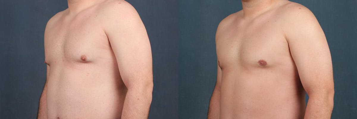 Male Reduction Before & After Gallery - Patient 272709 - Image 2