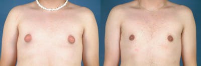 Male Breast Reduction Before & After Gallery - Patient 494671 - Image 1