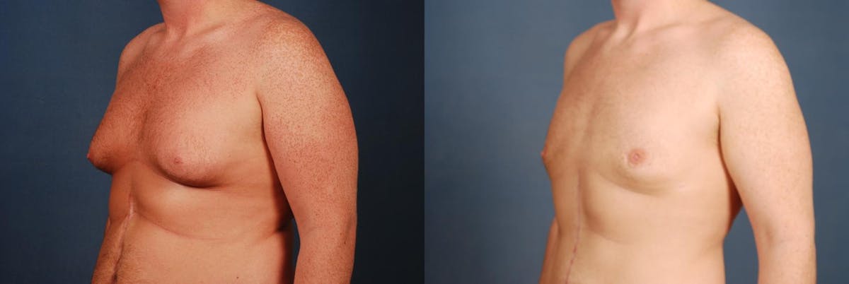 Male Breast Reduction Before & After Gallery - Patient 760868 - Image 2