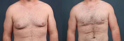 Male Breast Reduction Before & After Gallery - Patient 275474 - Image 1